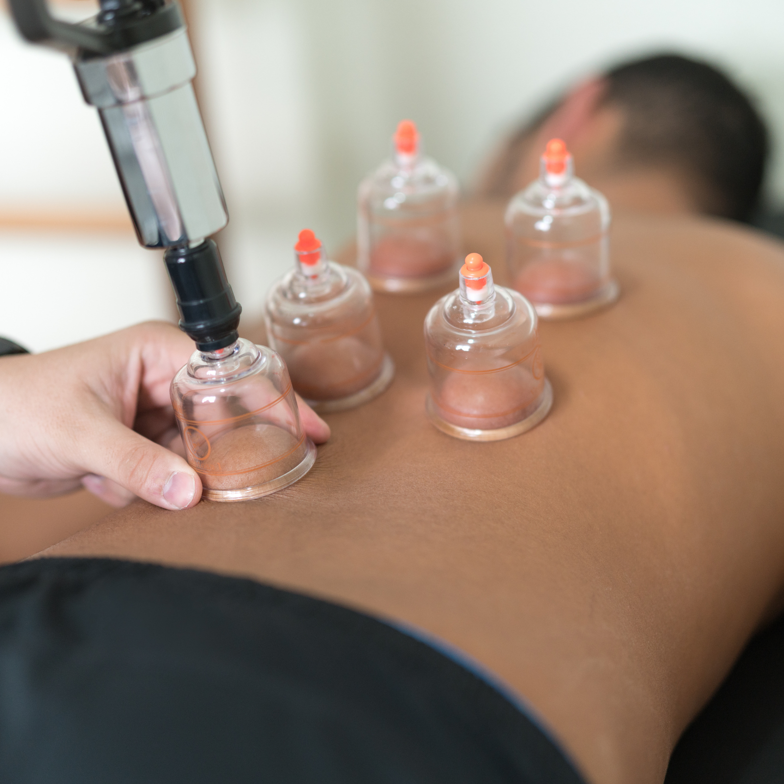 Cupping Therapy